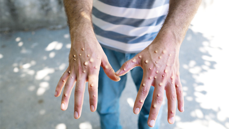 MAYMUN ÇİÇEĞİ NEDİR