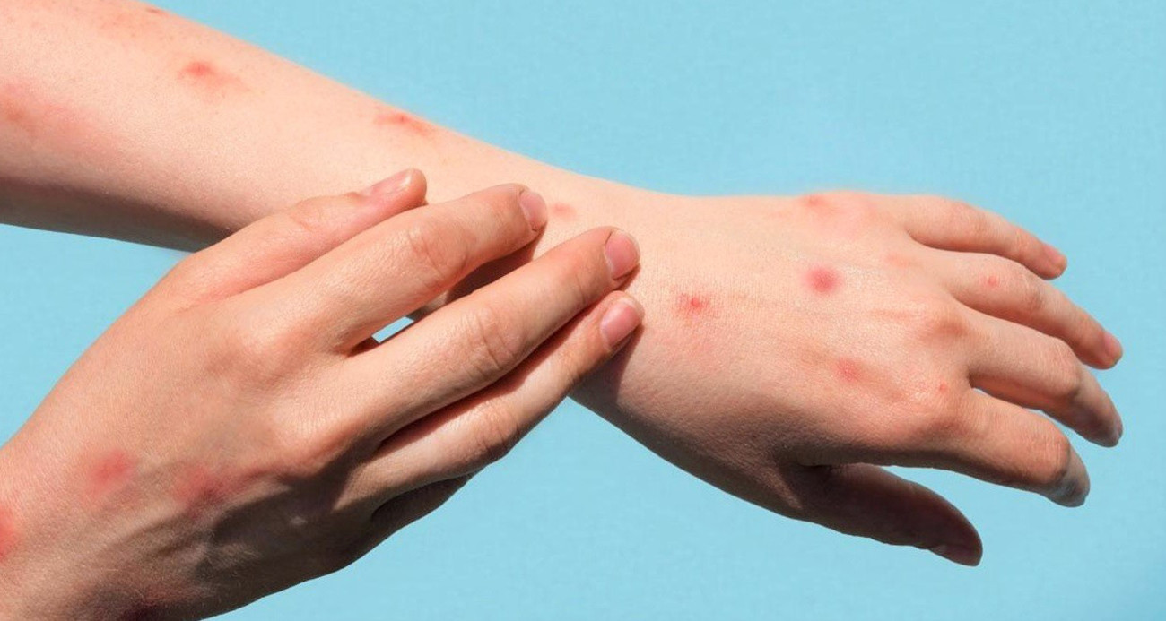 MAYMUN ÇİÇEĞİ TEDAVİSİ VAR MI