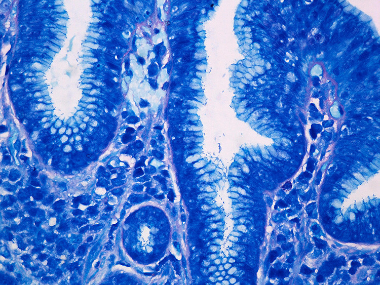 HELİKOBAKTER PİLORİ (H. PYLORİ)