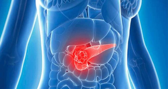 Pankreas kanseri nedir, belirtileri nelerdir Survivor Hasanın hastalığı pankreas kanseri nasıl anlaşılır, neden olur, tedavisi var mı İşte risk artıran faktörler