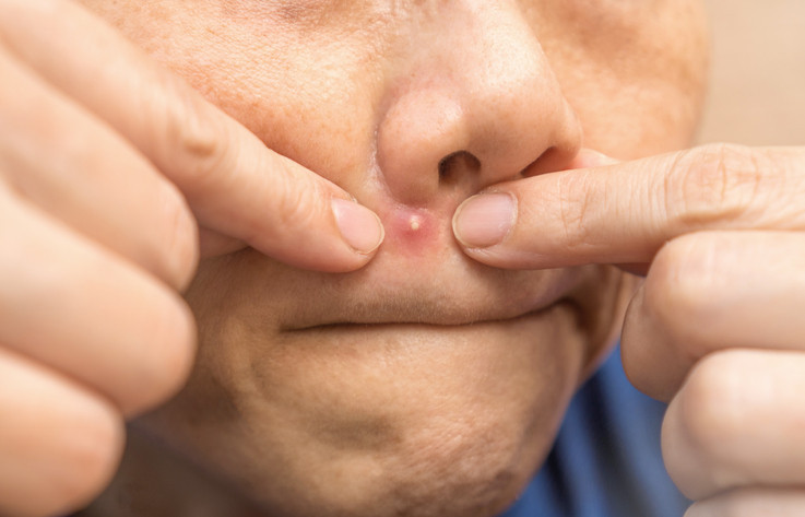 Söylenenler çok korkunç Ölüm üçgenindeki sivilceleri sıkmak tehlikeli mi Burada bir enfeksiyon oluşması halinde...