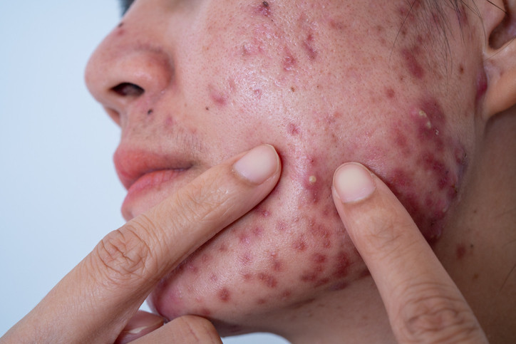 Söylenenler çok korkunç Ölüm üçgenindeki sivilceleri sıkmak tehlikeli mi Burada bir enfeksiyon oluşması halinde...