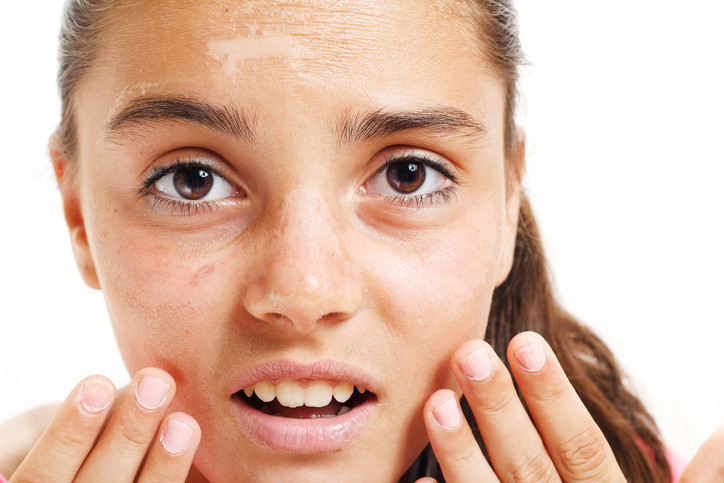 Güneş lekelerinden kurtulmak mümkün mü Evde yapılan peelingler, doğal maskeler ya da yüz masajları işe yarar mı