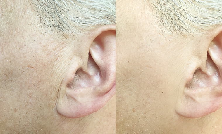 YÜZ GERME İŞLEMİ TAM OLARAK NASIL YAPILIYOR