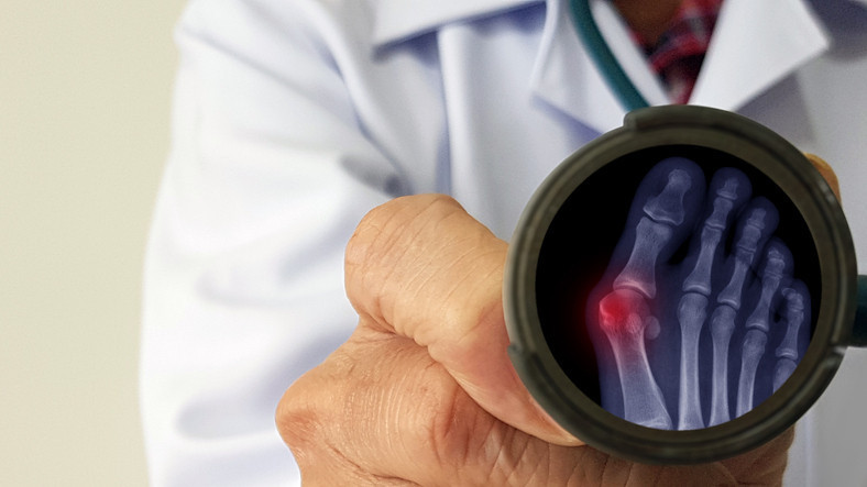 Halluks valgus tedavisi nasıl yapılır