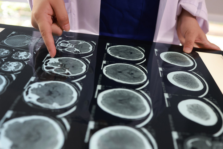 Kan grubunuz felç riskinizi etkileyebilir ‘65 yaş ve üzerini etkiliyordu ama gençlerde artmaya başladı’