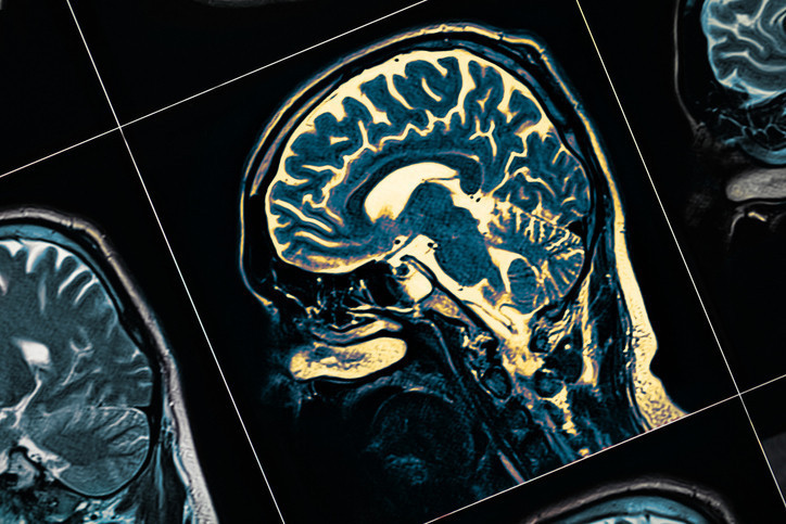 Alzheimer tedavisinde çığır açan keşif: Biberiye ve ada çayı ile yeni bir umut