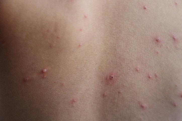 A VİTAMİNİ EKSİKLİĞİ KIZAMIK ENFEKSİYONLARINI ŞİDDETLENDİREBİLİR A VİTAMİNİ EKSİKLİĞİ KIZAMIK ENFEKSİYONLARINI ŞİDDETLENDİREBİLİR