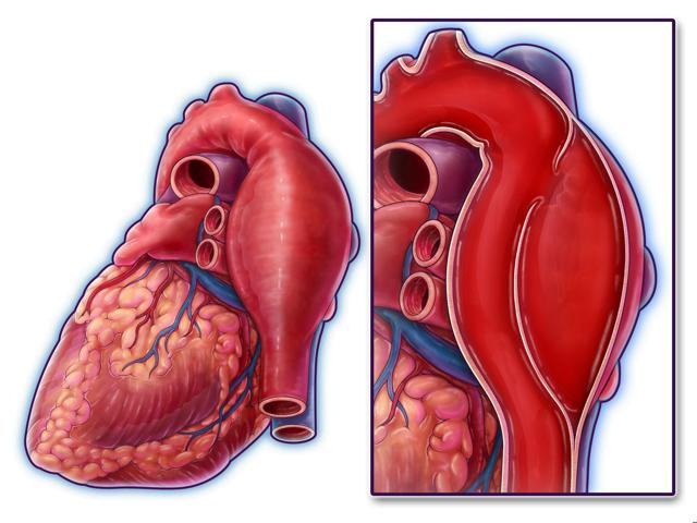 40-60 yaş arası en riskli grup Aort yırtılması kalp krizi ve felçle sonuçlanabilir