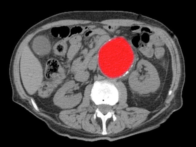 KONTROLSÜZ TANSİYONU BULUNANLAR DİKKAT YILDA BİR TOMOGRAFİ ŞART