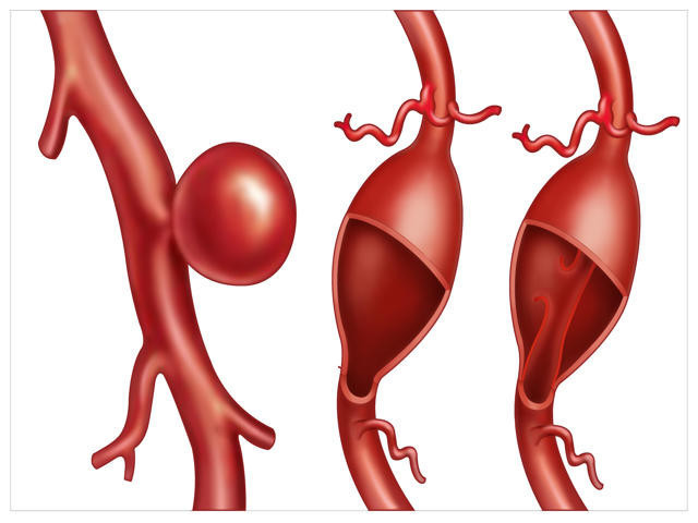 40-60 yaş arası en riskli grup Aort yırtılması kalp krizi ve felçle sonuçlanabilir