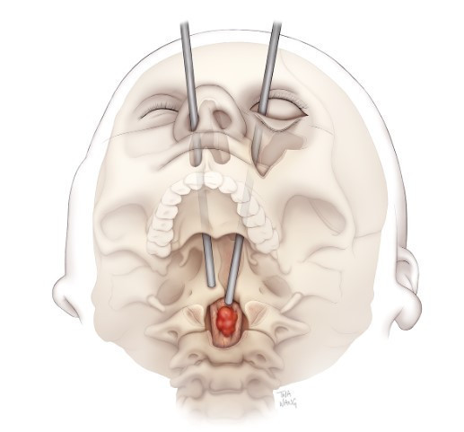Tıp dünyası için yeni bir sayfa: Hastanın gözünden omurga kanseri tümörünü çıkardılar