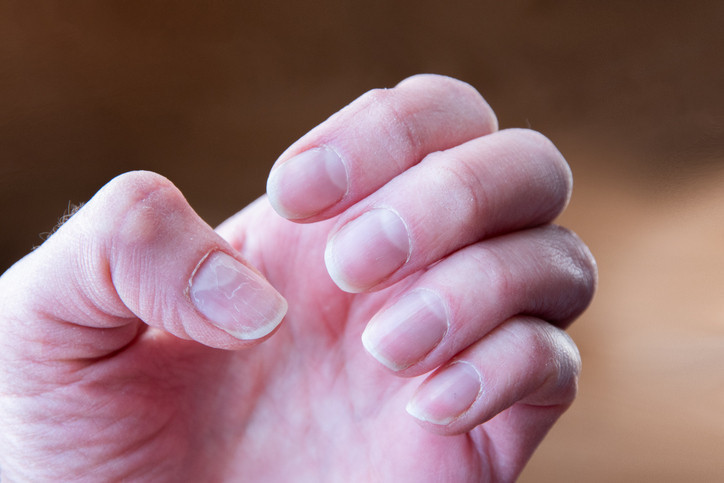 Ölümcül hastalığın sessiz işareti: Parmaklarda görülen bu değişikliğe dikkat Basit bir testle anlamak mümkün… Ölümcül hastalığın sessiz işareti: Parmaklarda görülen bu değişikliğe dikkat Basit bir testle anlamak mümkün…