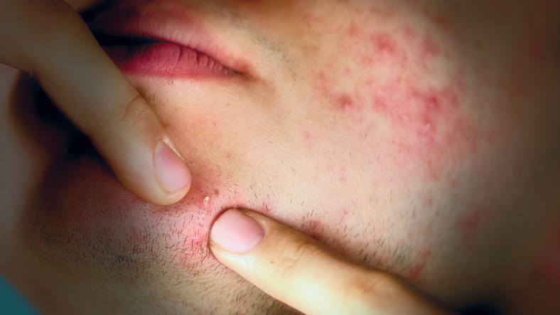 HER YIL YAKLAŞIK 3,6 MİLYON AMERİKALIYA BAZAL HÜCRELİ KARSİNOM TEŞHİSİ KONUYOR HER YIL YAKLAŞIK 3,6 MİLYON AMERİKALIYA BAZAL HÜCRELİ KARSİNOM TEŞHİSİ KONUYOR