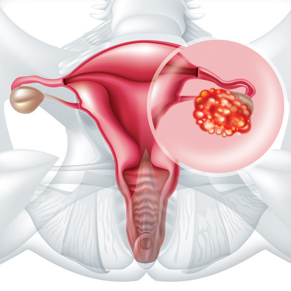 SORU: Miyomlar hamile kalmayı engeller mi