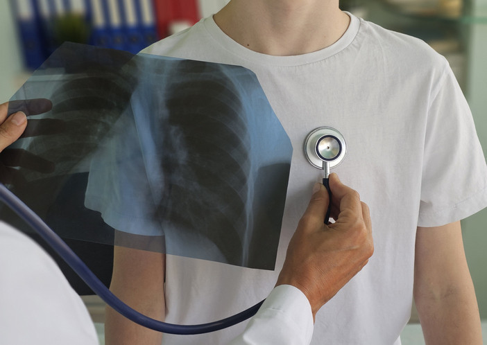 Tomografi ile kaburga kırığı saptanıyor Tomografi ile kaburga kırığı saptanıyor