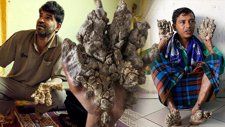 Vücudu ağaç kabuğuna dönüştüren hastalık “Ellerimi kesin” diye yalvardı Vücudu ağaç kabuğuna dönüştüren hastalık “Ellerimi kesin” diye yalvardı