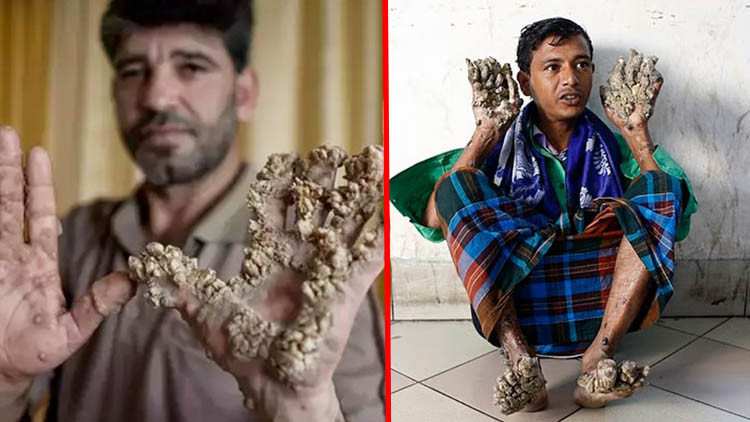 Vücudu ağaç kabuğuna dönüştüren hastalık! “Ellerimi kesin” diye yalvardı