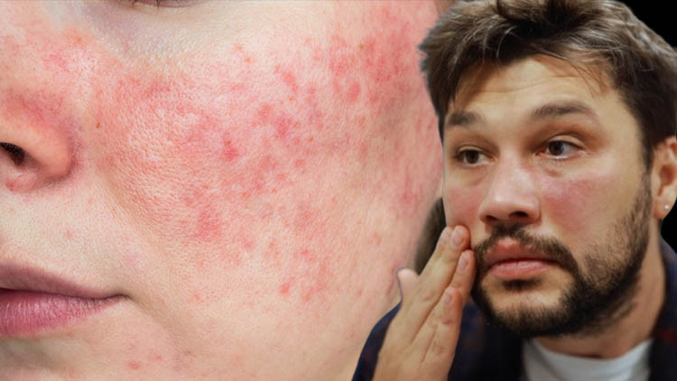 ‘Sonbahar yüzü’ alarmı! Bu belirtileriniz varsa dikkat… Cilt bariyeriniz çökmek üzere olabilir