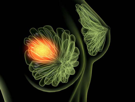 Meme kanseri hakkında kadınların pek bilmediği ama aslında çok önemli olan gerçekler nelerdir