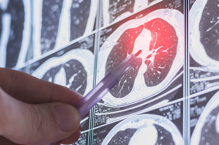 Ülkemizde her yıl yaklaşık 41 bin kişi akciğer kanserine yakalanıyor Bu kanserin yüzde 85’inden sigara sorumlu