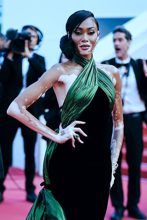 Alay edilen hastalığı onun şansı oldu... Şimdi büyük bir şöhreti ve bir sürü parası var... Yine kırmızı halının yıldızı oldu Alay edilen hastalığı onun şansı oldu... Şimdi büyük bir şöhreti ve bir sürü parası var... Yine kırmızı halının yıldızı oldu