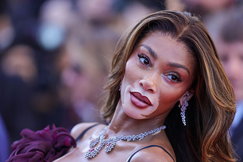 Alay edilen hastalığı onun şansı oldu... Şimdi büyük bir şöhreti ve bir sürü parası var... Yine kırmızı halının yıldızı oldu Alay edilen hastalığı onun şansı oldu... Şimdi büyük bir şöhreti ve bir sürü parası var... Yine kırmızı halının yıldızı oldu