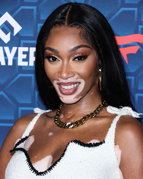 Alay edilen hastalığı onun şansı oldu... Şimdi büyük bir şöhreti ve bir sürü parası var... Yine kırmızı halının yıldızı oldu Alay edilen hastalığı onun şansı oldu... Şimdi büyük bir şöhreti ve bir sürü parası var... Yine kırmızı halının yıldızı oldu