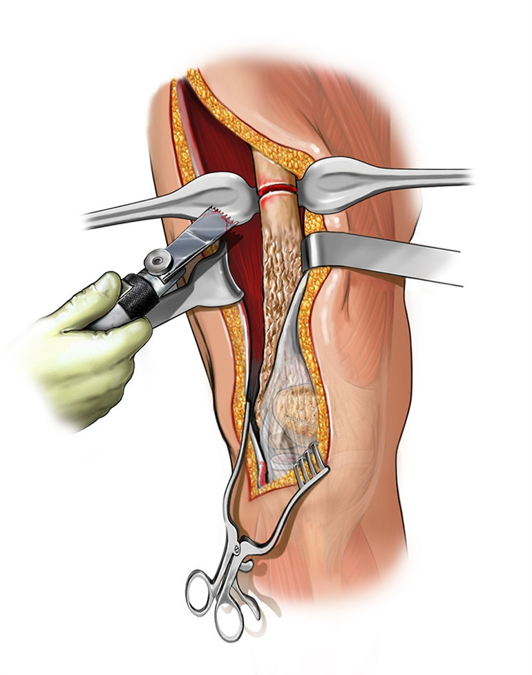  Kemikleri günde yaklaşık 1 milimetre uzatıyor