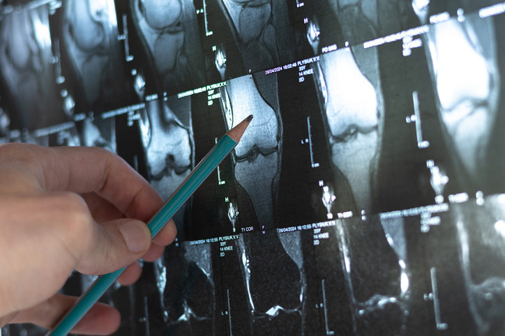  Kemikleri günde yaklaşık 1 milimetre uzatıyor