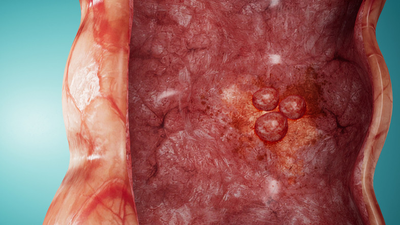 Ağrısız gelişiyor, sinsice ilerliyor Murat Cemcir’i yoğun bakımlık eden hastalık divertikül kanaması