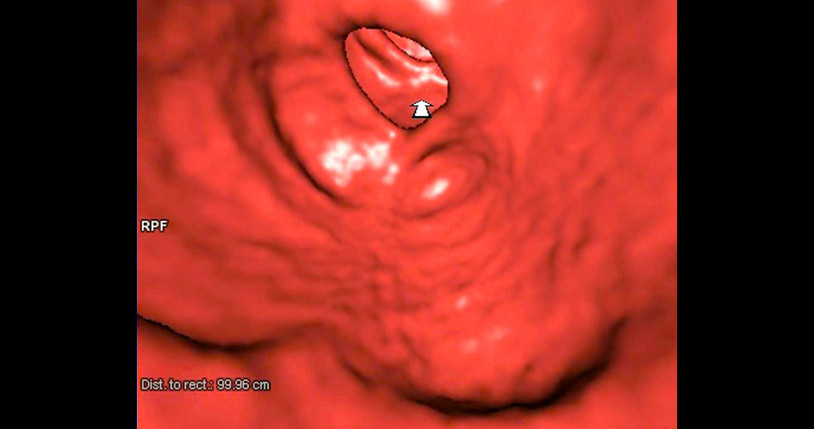 Ağrısız gelişiyor, sinsice ilerliyor Murat Cemcir’i yoğun bakımlık eden hastalık divertikül kanaması