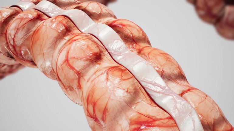 Ağrısız gelişiyor, sinsice ilerliyor Murat Cemcir’i yoğun bakımlık eden hastalık divertikül kanaması