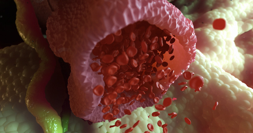 Ağrısız gelişiyor, sinsice ilerliyor Murat Cemcir’i yoğun bakımlık eden hastalık divertikül kanaması