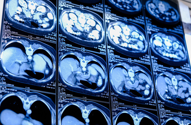 YAŞLI NÜFUS VE YENİ GRİP DALGALARI ZATÜRREYİ DAHA RİSKLİ HALE GETİRİYOR