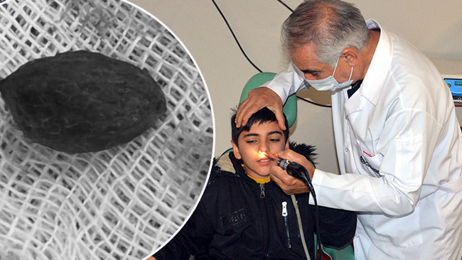 Kaşıntı şikayetiyle hastaneye gitti: Burnundan çıkanlara ailesi şaşırdı! 'Ameliyatta karşılaştık'