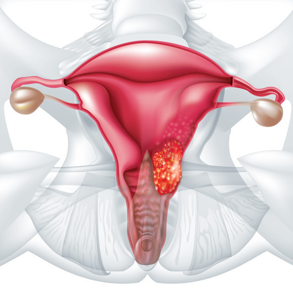 Yıllarca belirti vermeden sinsice ilerliyor Ölümcül kanserler arasında yer alıyor, 21 yaşından itibaren mutlaka…