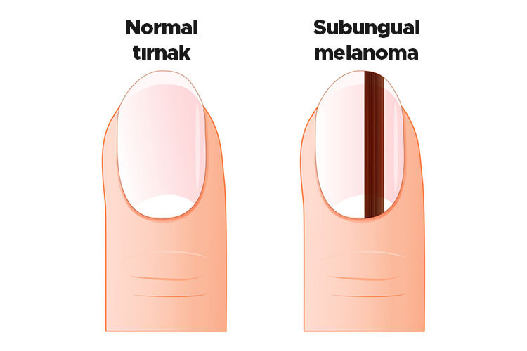 Tırnaklarının fotoğrafını gören herkes Hemen doktora git dedi Bu uyarının sebebi neydi