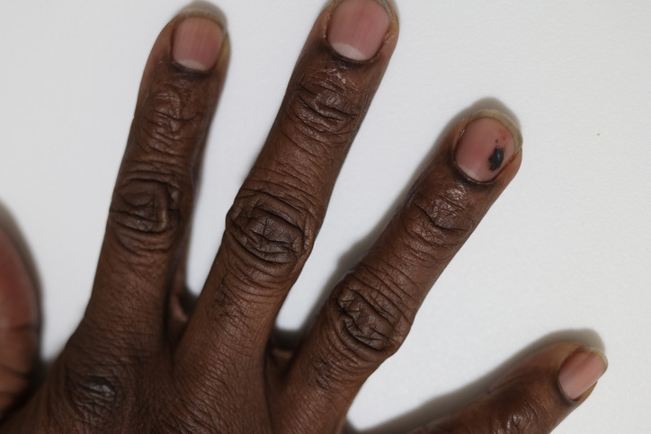 Tırnaklarının fotoğrafını gören herkes Hemen doktora git dedi Bu uyarının sebebi neydi