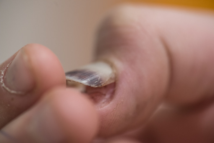 Tırnaklarının fotoğrafını gören herkes Hemen doktora git dedi Bu uyarının sebebi neydi