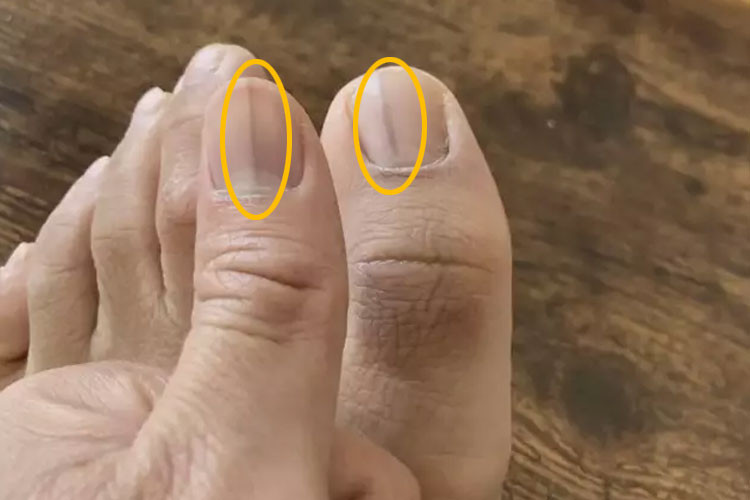 Tırnaklarının fotoğrafını gören herkes Hemen doktora git dedi Bu uyarının sebebi neydi