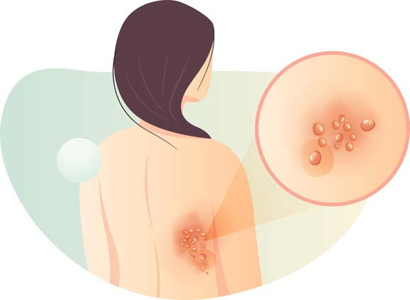  Vücudunuzdaki virüs her an uyanabilir