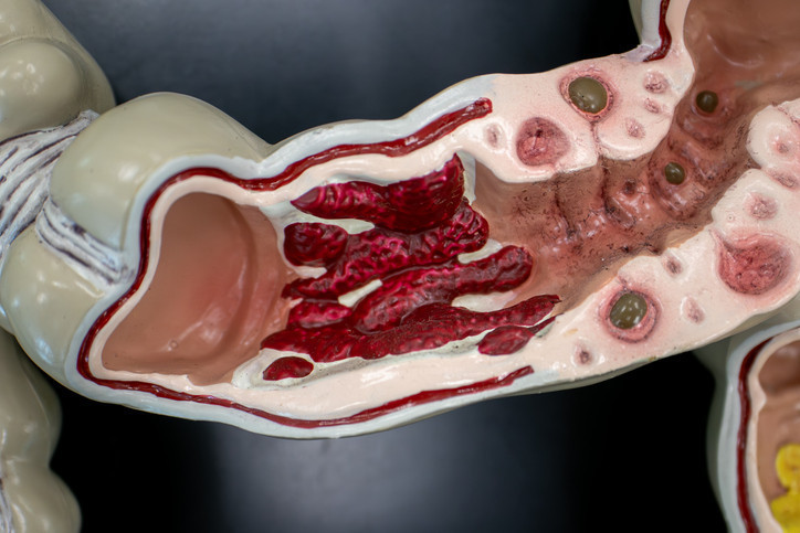 TANISI VE TEDAVİSİ NASIL