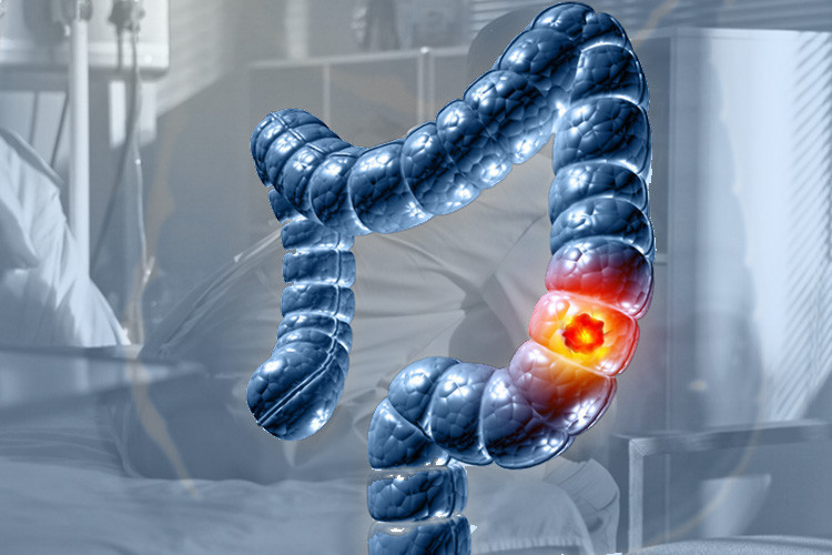 Uzmanlar şokta! Çok kısa sürede en ölümcül kanser oldu: Bu kadar hızlı ilerlemesini bilim insanları da beklemiyordu