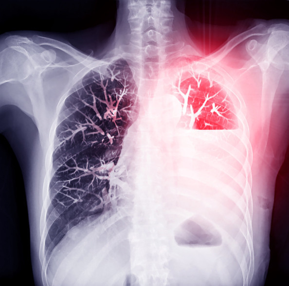 Bir anda başlıyor, hızla nefesi kesebiliyor Özellikle 15 – 30 yaş grubundaki erkekler risk altında