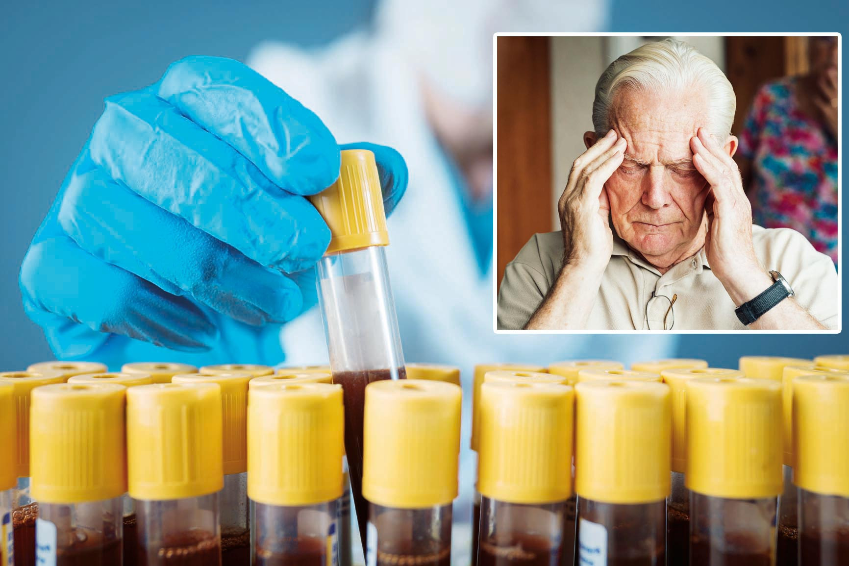 Kan testiyle Alzheimer’a erken teşhis