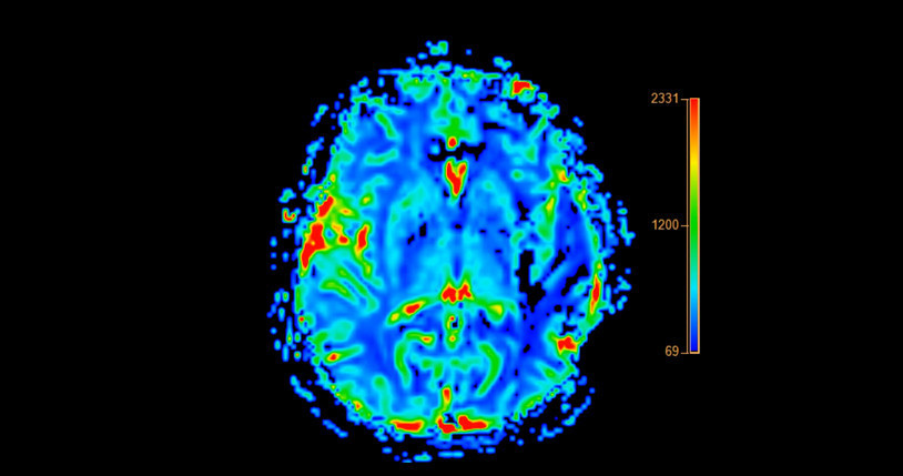 Sağlıklı sanıyorsunuz ama... Beynin koruma kalkanını deliyor, Alzheimer’ı tetikliyor