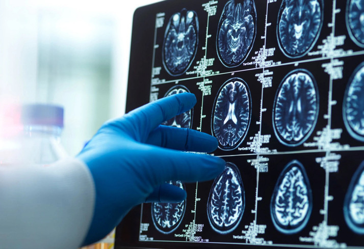 UZUN VADEDE BEYNİ ETKİLİYOR