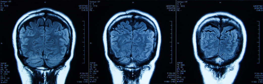 Yıllarca sıradan baş ağrısı sandı, hayatı tamamen değişti Bir sabah konuşamaz oldu… Bu belirtilere dikkat