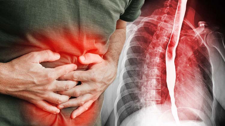 Kronik mide yanması yaşadığını sanıyordu, dördüncü evre kanser çıktı! Ölümün kıyısından nasıl döndü?